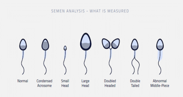 Fig 3: A normal-shaped sperm cell (far left), and abnormal sperm cells (all other cells to the right).